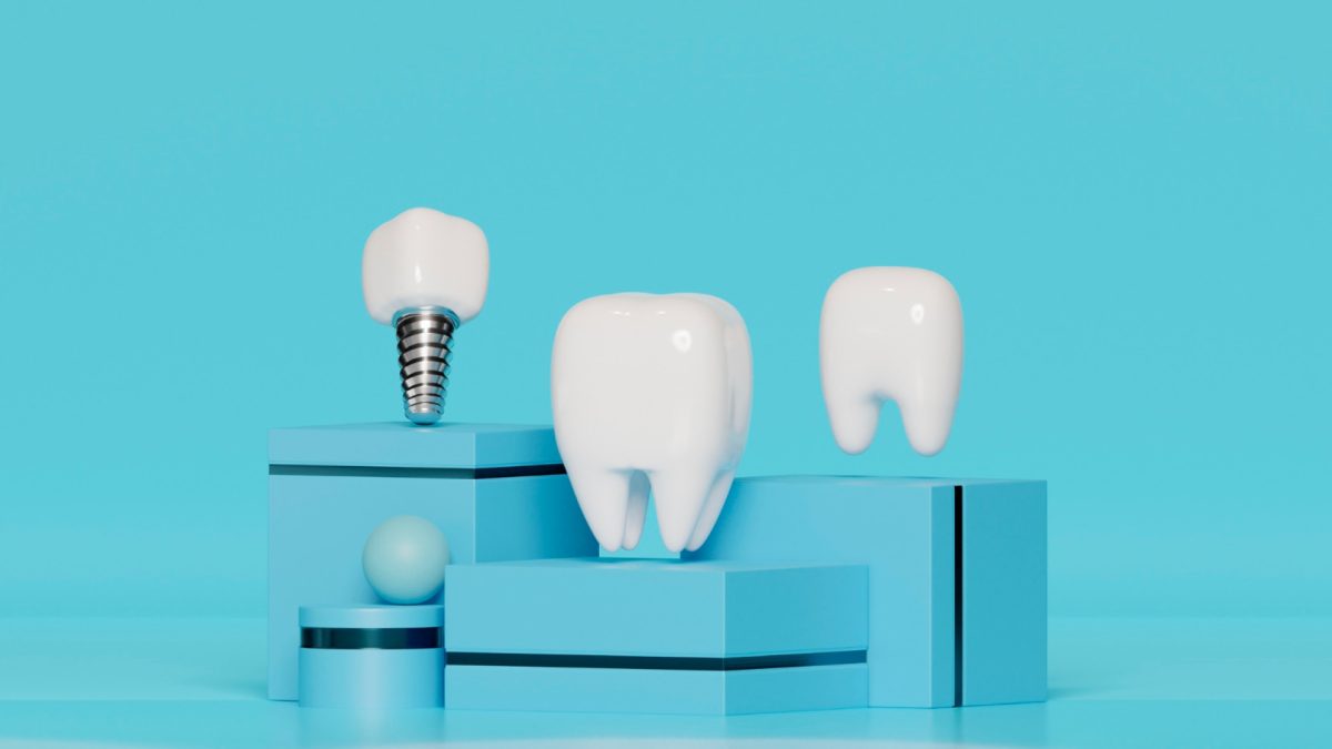 Tout savoir sur l’implant dentaire : avantages, déroulement et résultats