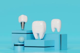 Tout savoir sur l’implant dentaire : avantages, déroulement et résultats